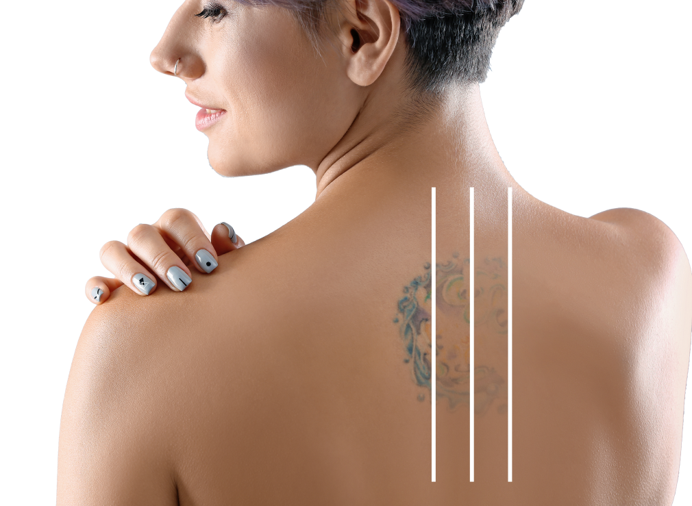 Tattoo Removal Brisbane